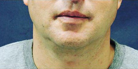 Front view of chin of male patient after Sculpsure treatment