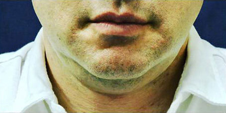 Front view of chin of male patient before Sculpsure treatment