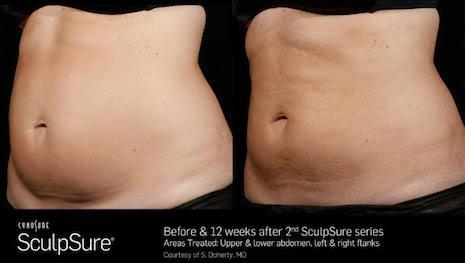 SculpSure before and 12 weeks after female abdomen