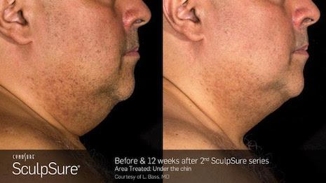 SculpSure Before and 12 weeks after male chin treatment