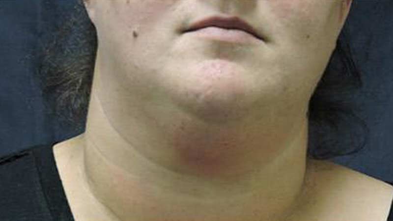 Female's double chin after SculpSure non-surgical treatment at Elkins Park Family Medicine