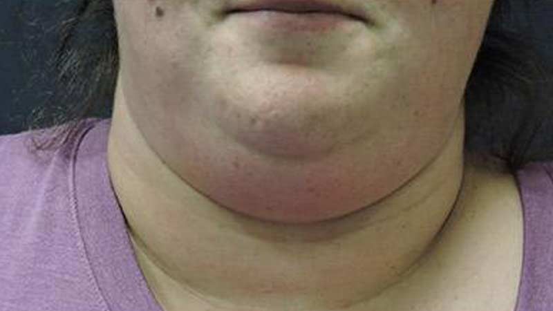 Female's double chin before SculpSure non-surgical treatment at Elkins Park Family Medicine