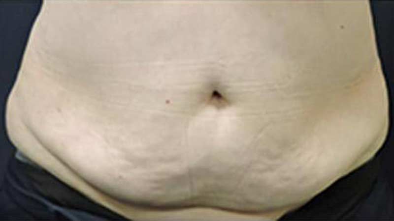 Front view of a female abdomen after SculpSure treatment at Elkins Park Family Medicine