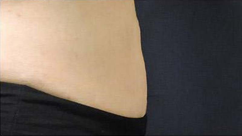 Profile view of a female abdomen after SculpSure treatment at Elkins Park Family Medicine