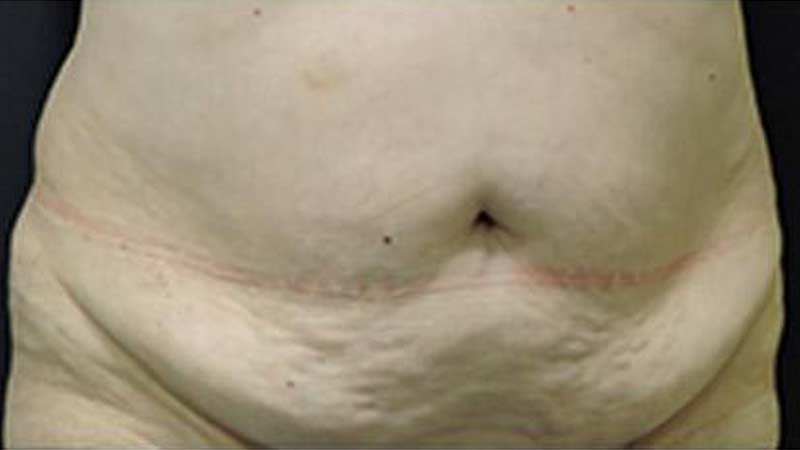 Front view of a female abdomen before SculpSure treatment at Elkins Park Family Medicine