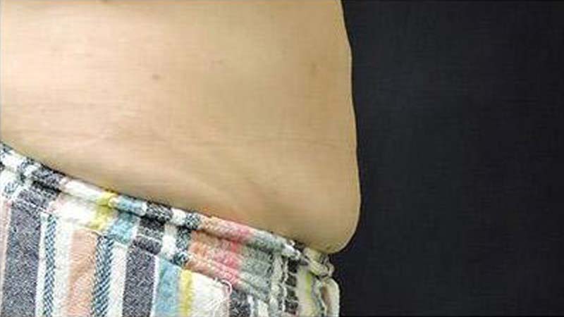 Profile view of a female abdomen before SculpSure treatment at Elkins Park Family Medicine