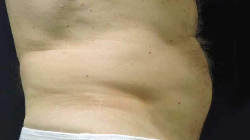 Profile view of a male's abdomen after SculpSure treatment at Elkins Park Family Medicine