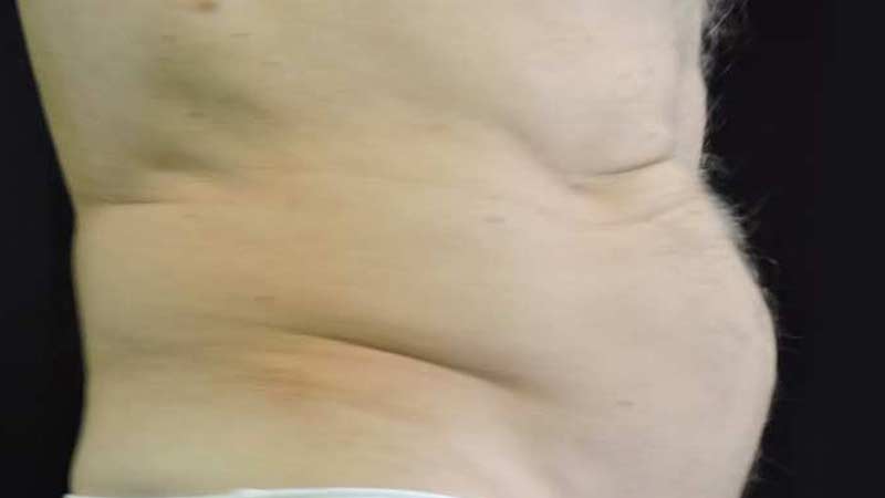 Profile view of a male's abdomen before SculpSure treatment at Elkins Park Family Medicine