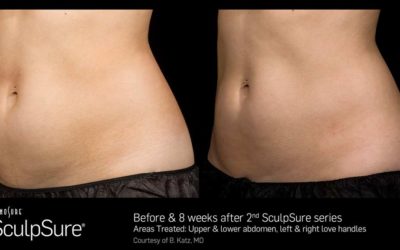 5 Reasons Why Body Sculpting with SculpSure Remains So Popular