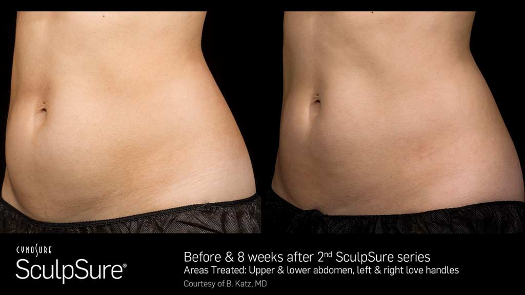 Young woman SculpSure before and 8 weeks after comparison